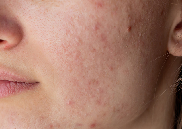 Acne treatment before and after results